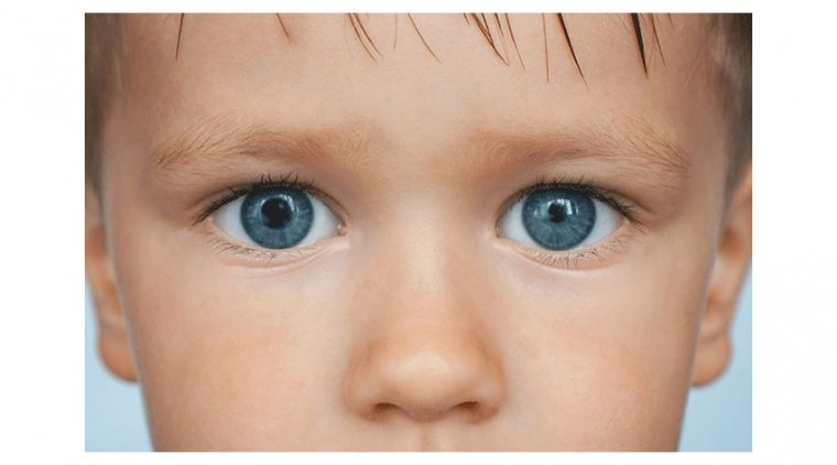 Anisocoria: When Pupils Don't Play By The Same Rules