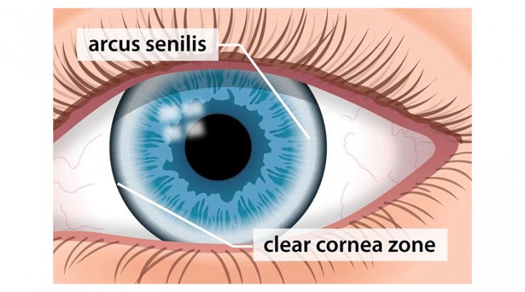 Arcus Senilis: Understanding Causes, Symptoms, and Treatment