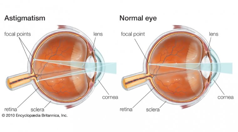 Astigmatism: An Overview of Visual Distortion