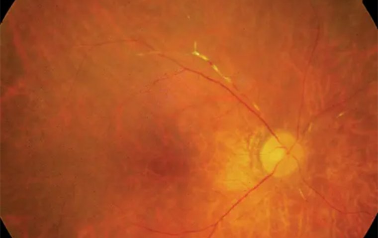 Autoimmune Retinopathy: Insights into a Rare Eye Disorder 