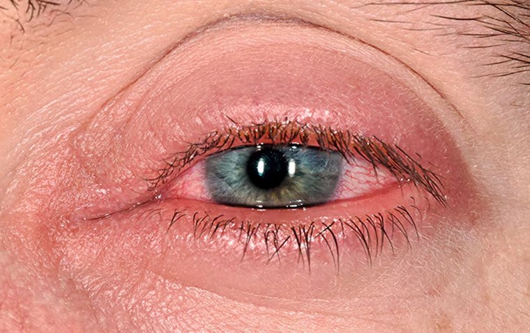 Bimekizumab Significantly Reduces Uveitis Incidence in axSpA Patients