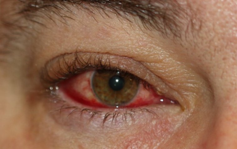 Blepharoconjunctivitis: A Closer Look at Its Causes and Treatment