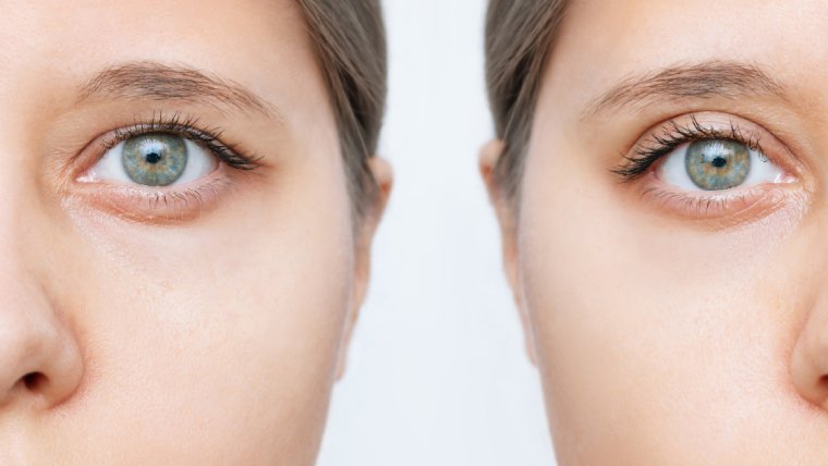 Blepharoplasty: A Game-Changer for Tired-Looking Eyes
