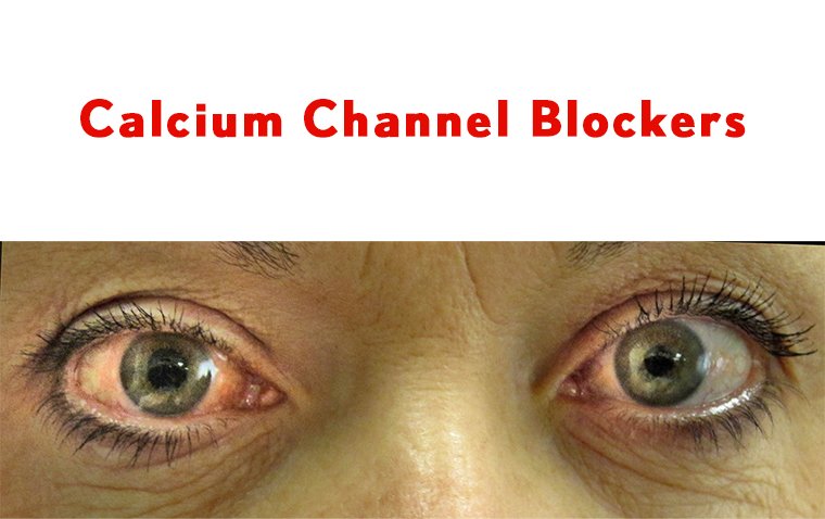 Calcium Channel Blockers Linked to Increased Risk of Glaucoma, Study Shows