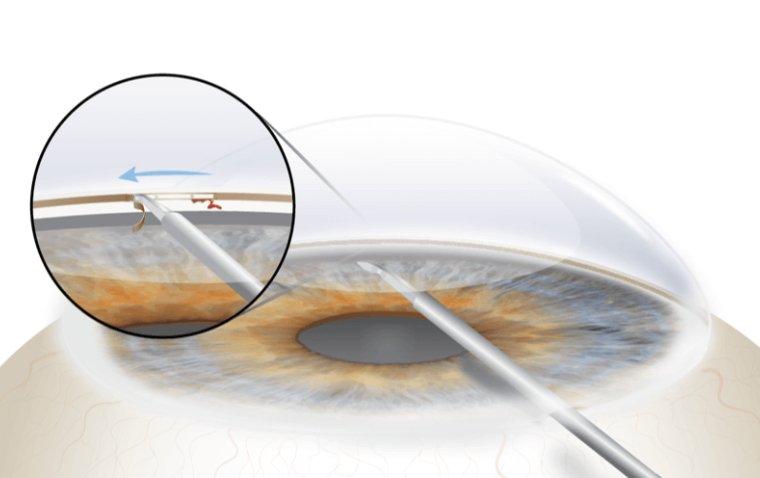 Cataract Surgery & Goniotomy