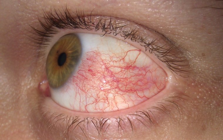 Conjunctival Hyperemia: Causes, Complications, and Solutions