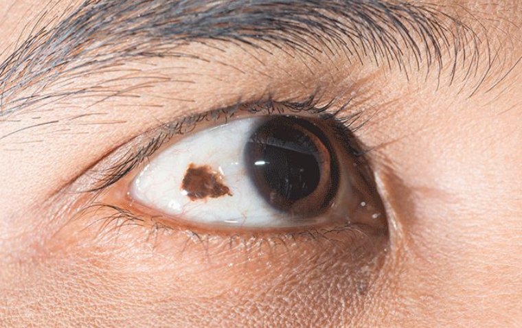 Conjunctival Nevus: A Benign Growth on the Eye's Surface