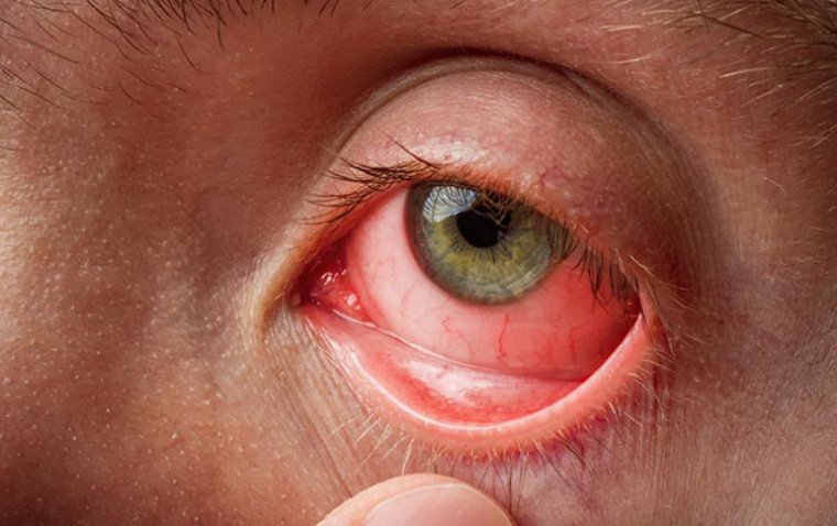 Conjunctivitis: Causes, Symptoms, and Effective Management