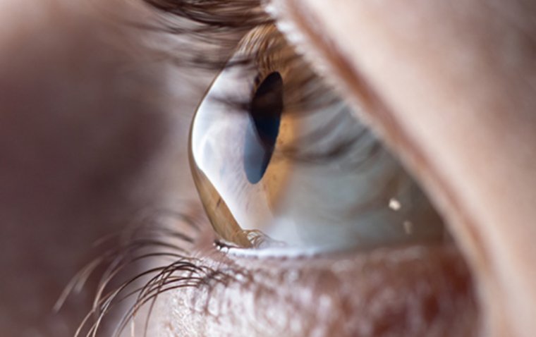 Corneal Ectasia: Causes, Symptoms and Treatment Options