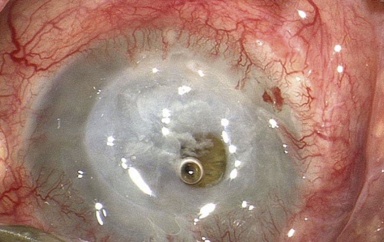 Corneal Melt: A Rare but Vision-Threatening Condition