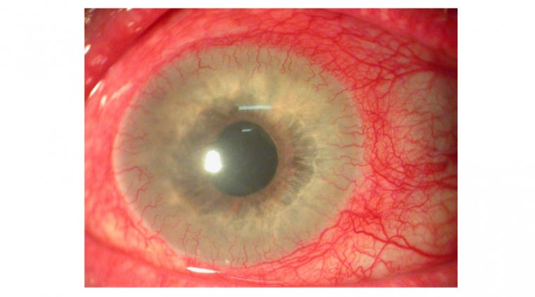 Corneal Neovascularization: Causes and Emerging Treatments
