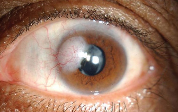 Corneal Opacity: Symptoms and Signs to Watch Out For