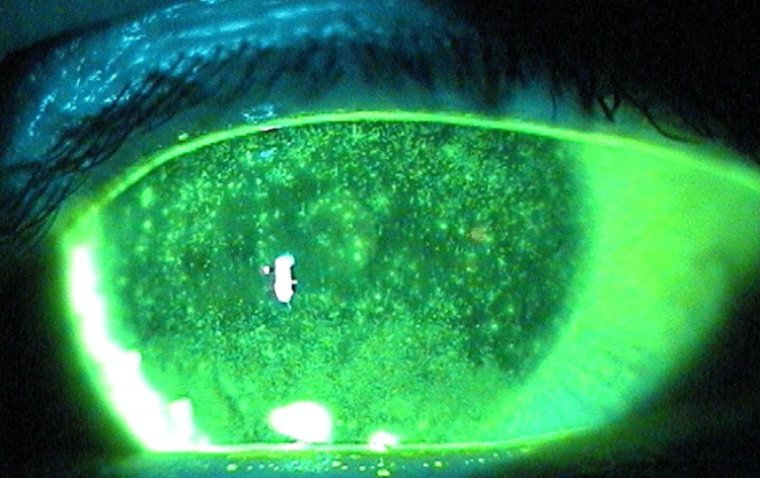 Corneal Staining: An In-Depth Examination of Causes and Effects