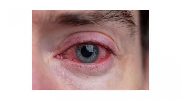 Corneal Swelling After Cataract Surgery