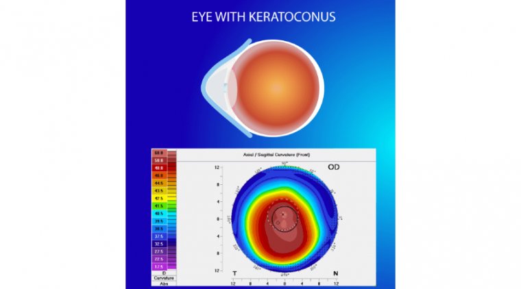 Correlation between Keratoconus and Dry Eye Disease