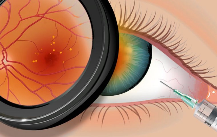 Could Eye Drops Replace Eye Injections for Retinal Vein Occlusion?