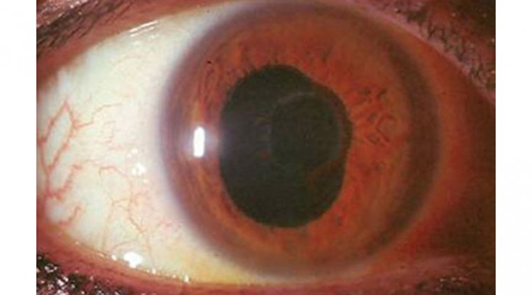 Cycloplegia: The Eye Condition That Affects Your Ability to Focus Up Close