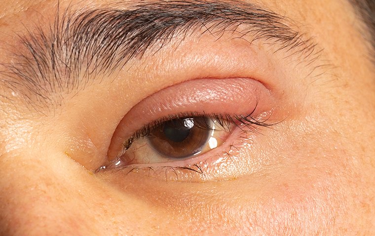 Dacryoadenitis: Understanding Lacrimal Gland Inflammation