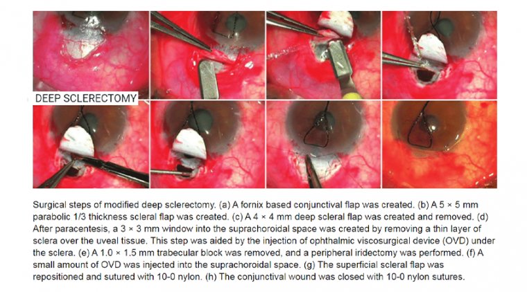 Deep Sclerectomy Surgery