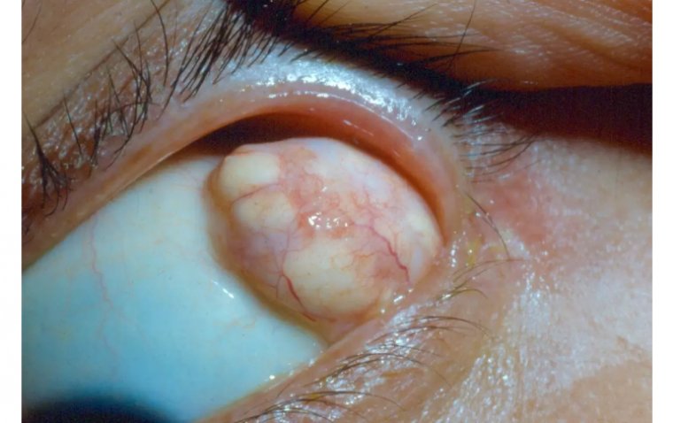 Dermolipoma: A Rare Benign Tumor of the Eye 