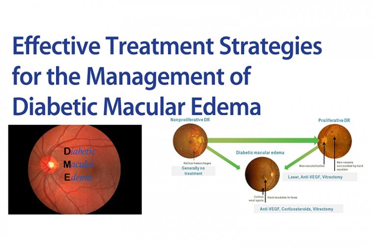Diabetic Macular Edema & Treatment Strategies