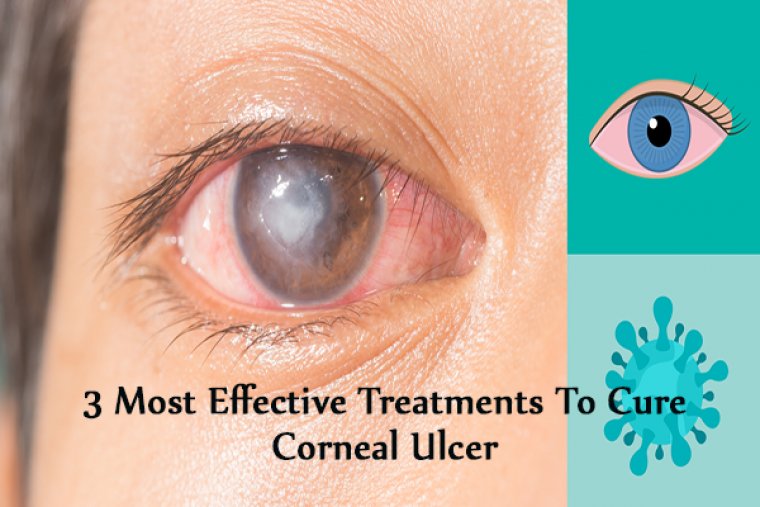 Diagnosis and Treatment of Corneal Ulcers