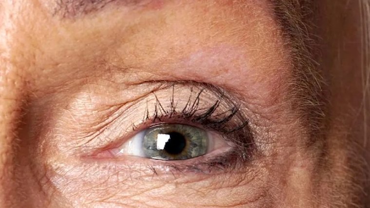 Dysphotopsia: Visual Phenomena After Cataract Surgery