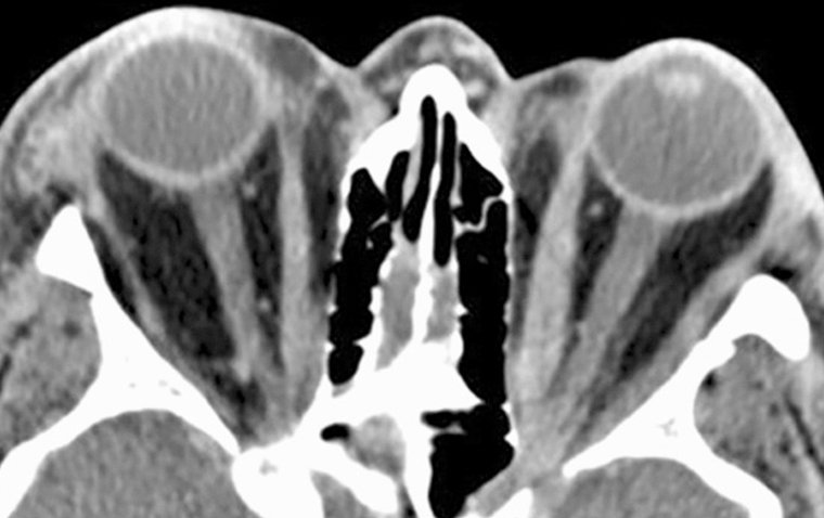 Dysthyroid Optic Neuropathy: Thyroid Dysfunction and Ocular Impact