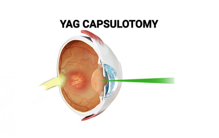 Enhancing Vision Clarity: The Power of YAG Laser Capsulotomy