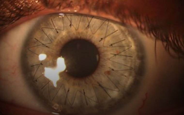 Explained: Why Do Some Corneal Transplants Fail? 