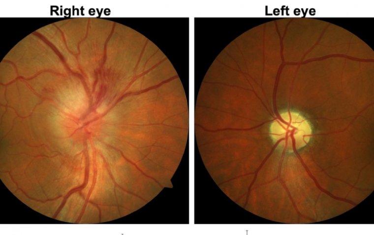 Exploring Ischemic Optic Neuropathy and its Impact on Vision
