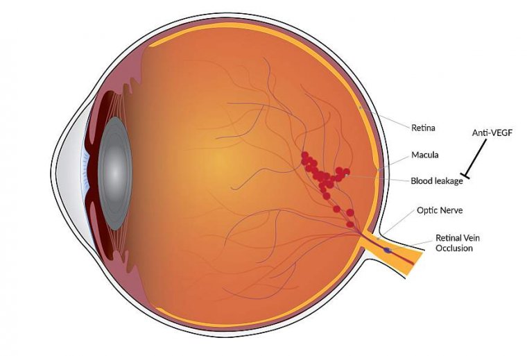 Exploring Retinal Vascular Occlusion: Causes and Treatments