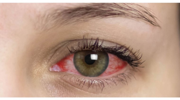 Exploring the Causes and Treatments of Anterior Uveitis