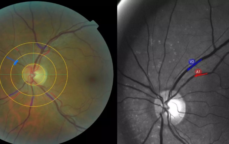 Eye Exams as a Novel Frontier in Long COVID Testing