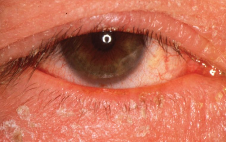 Eyes Irritated? It Could Be Squamous Blepharitis 