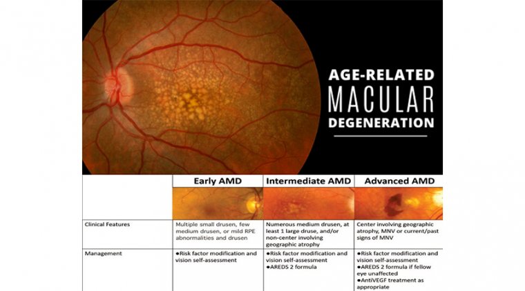 General Stages of AMD & Management