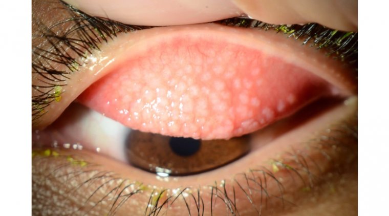 Understanding Giant Papillary Conjunctivitis: Causes and Triggers