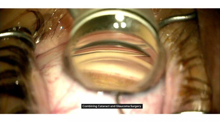 Glaucoma Filtration Surgery Combined With Cataract Extraction