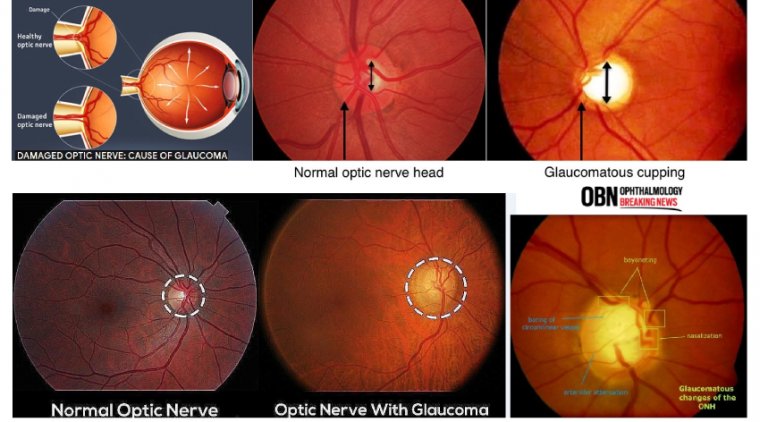 Glaucomatous Optic Nerve Damage 