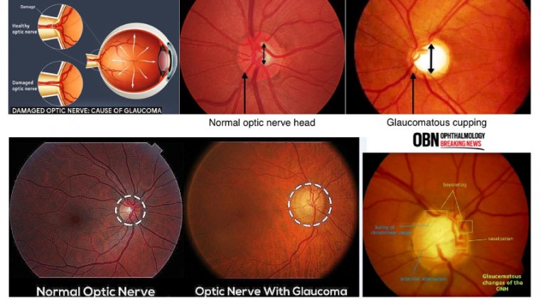 Glaucomatous Optic Nerve Damage OBN