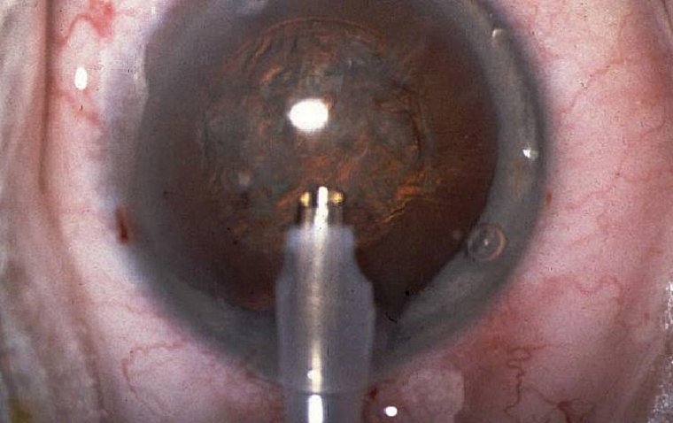 Goniosynechialysis: Surgery Insights for Glaucoma Management