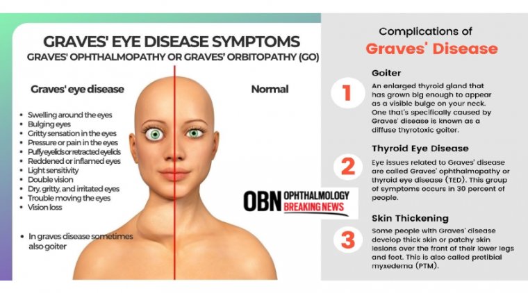 Graves’ Eye Disease (Graves’ Ophthalmopathy or Graves’ Orbitopathy)