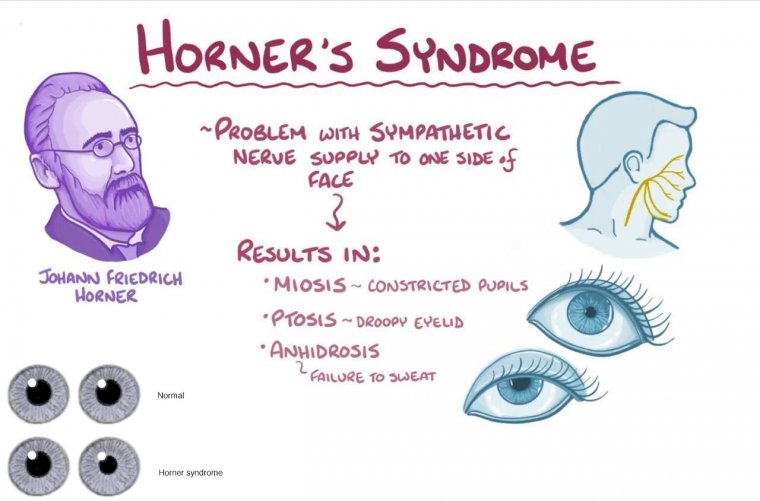 Australia cocina Estudiante Horner Syndrome Symptoms, Causes, Treatment | OBN