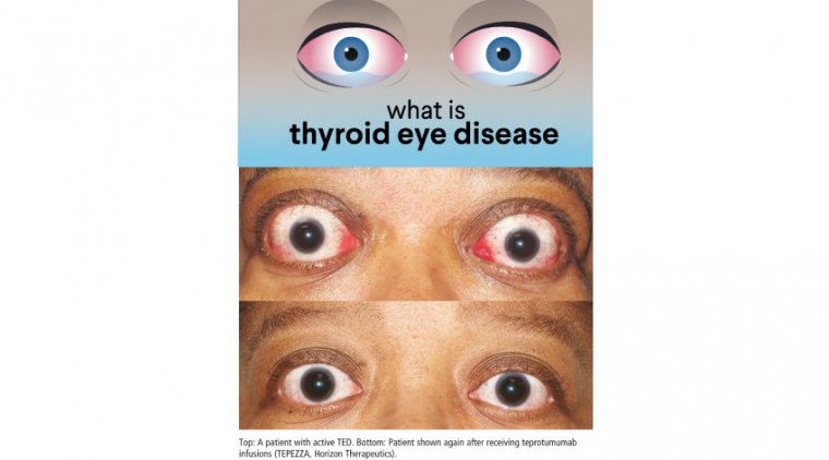 How to Diagnose and Treat Thyroid Eye Disease
