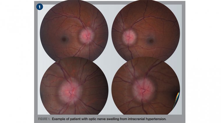 How to Diagnose Papilledema, A Swollen Optic Nerve?