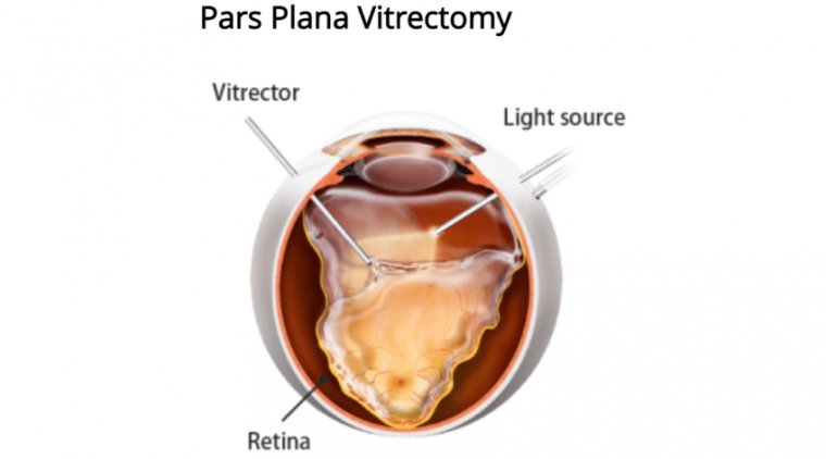 How to Educate the Patients for Pars Plana Vitrectomy (PPV)