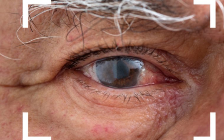 How to Manage Eye Irritation After Cataract Surgery: Tips and Effective Techniques