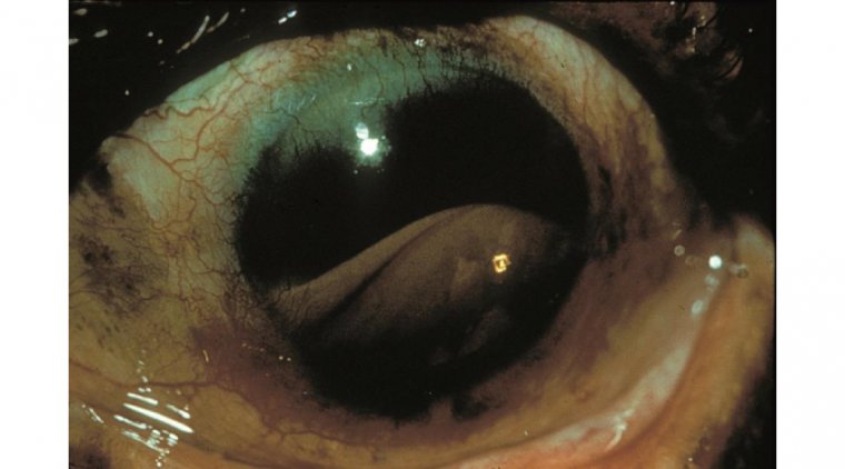 How to Recognize and Manage Symptoms of Ghost Cell Glaucoma