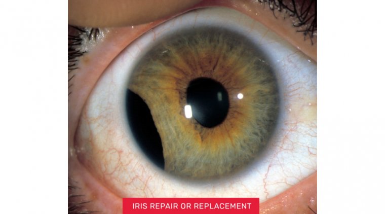 How to Repair Iris Trauma