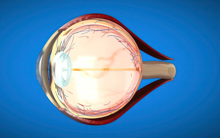 Human iPSC-Based Study Identifies Key Defects and Potential Therapies for AMD and Related Macular Dystrophies